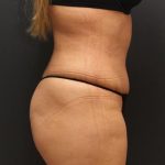 Liposuction Case 6862, After Treatment, Female Patient, Thumbnail 3