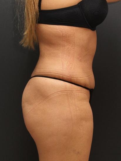 Liposuction Case 6862, After Treatment, Female Patient, Set 3