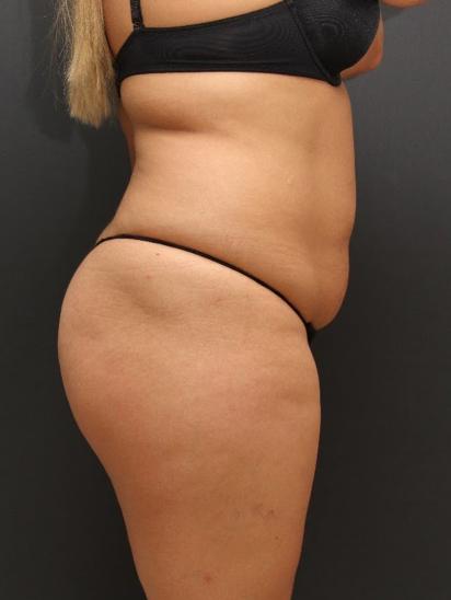 Liposuction Case 6862, Before Treatment, Female Patient, Set 3