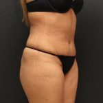 Liposuction Case 6862, After Treatment, Female Patient, Thumbnail 2