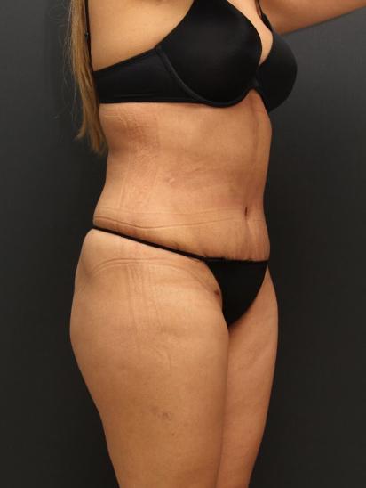 Liposuction Case 6862, After Treatment, Female Patient, Set 2