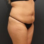 Liposuction Case 6862, Before Treatment, Female Patient, Thumbnail 2