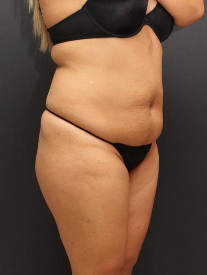 Liposuction Case 6862, Before Treatment, Female Patient, Set 2