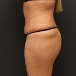 Liposuction Case 6862, After Treatment, Female Patient, Thumbnail 5