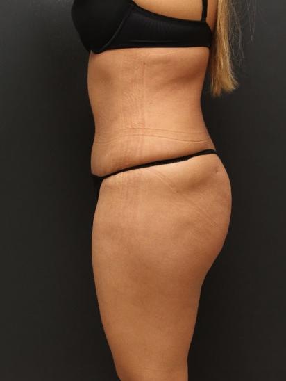 Liposuction Case 6862, After Treatment, Female Patient, Set 5