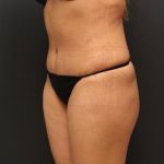 Liposuction Case 6862, After Treatment, Female Patient, Thumbnail 4
