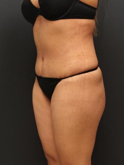Liposuction Case 6862, After Treatment, Female Patient, Set 4