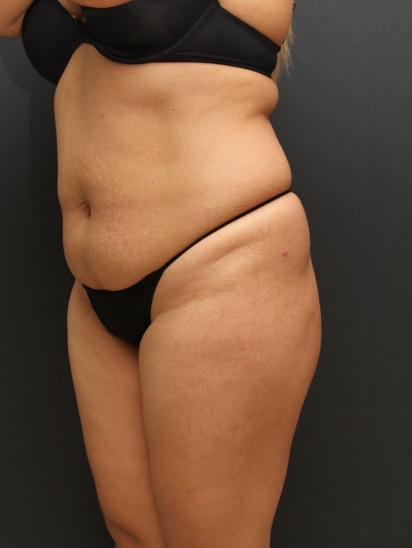 Liposuction Case 6862, Before Treatment, Female Patient, Set 4
