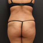 Liposuction Case 6862, After Treatment, Female Patient, Thumbnail 8