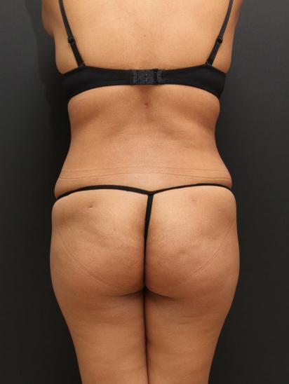 Liposuction Case 6862, After Treatment, Female Patient, Set 8