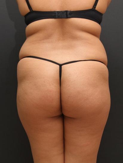 Liposuction Case 6862, Before Treatment, Female Patient, Set 8