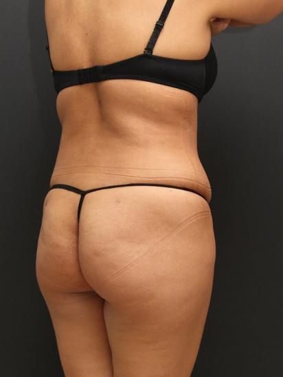 Liposuction Case 6862, After Treatment, Female Patient, Set 6