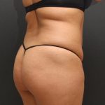 Liposuction Case 6862, Before Treatment, Female Patient, Thumbnail 6