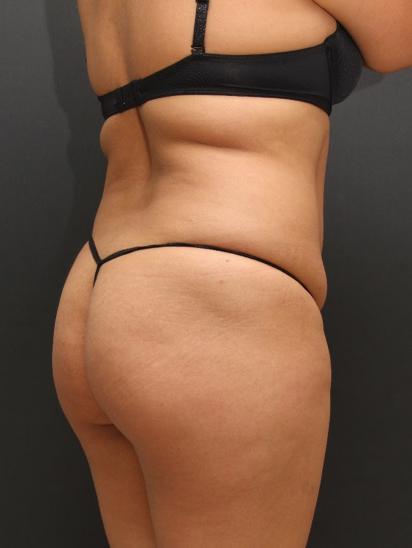 Liposuction Case 6862, Before Treatment, Female Patient, Set 6