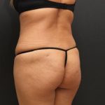 Liposuction Case 6862, After Treatment, Female Patient, Thumbnail 7