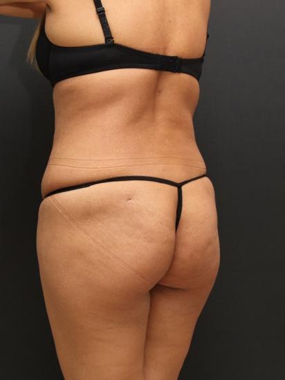 Liposuction Case 6862, After Treatment, Female Patient, Set 7