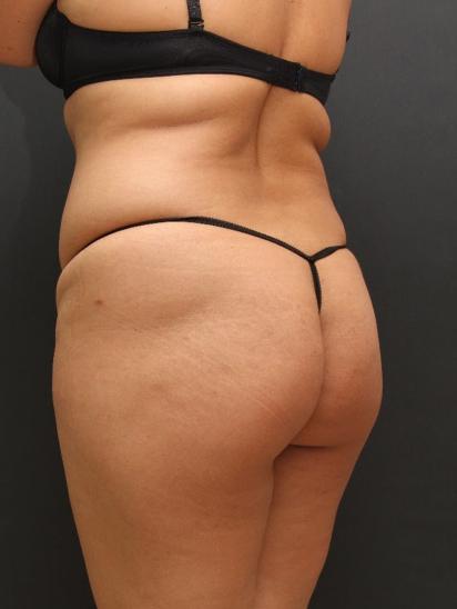 Liposuction Case 6862, Before Treatment, Female Patient, Set 7