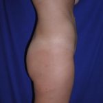 Liposuction Case 6863, After Treatment, Female Patient, Thumbnail 2