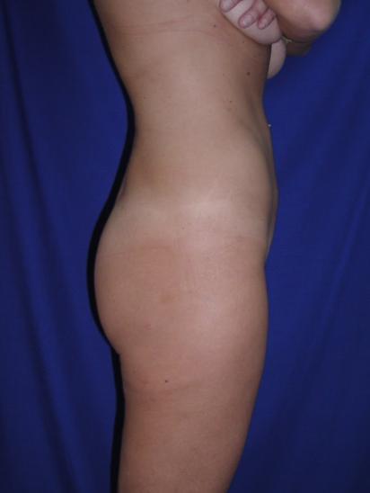 Liposuction Case 6863, After Treatment, Female Patient, Set 2