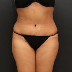 Tummy Tuck Case 6864, After Treatment, Female Patient, Thumbnail 1
