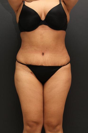 Female body, after Tummy Tuck treatment, front view (patient 1)