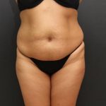 Tummy Tuck Case 6864, Before Treatment, Female Patient, Thumbnail 1