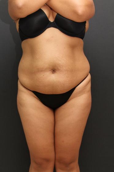Female body, before Tummy Tuck treatment, front view (patient 1)