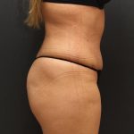 Tummy Tuck Case 6864, After Treatment, Female Patient, Thumbnail 3