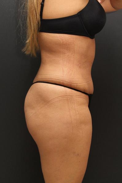 Tummy Tuck Case 6864, After Treatment, Female Patient, Set 3