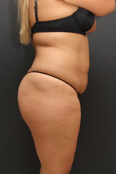 Tummy Tuck Case 6864, Before Treatment, Female Patient, Set 3