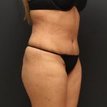 Tummy Tuck Case 6864, After Treatment, Female Patient, Thumbnail 2