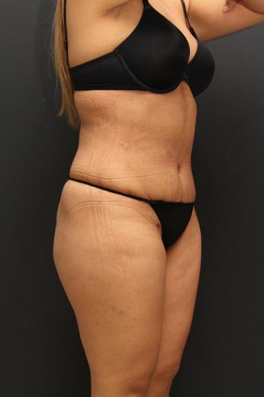 Tummy Tuck Case 6864, After Treatment, Female Patient, Set 2