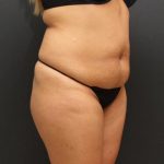 Tummy Tuck Case 6864, Before Treatment, Female Patient, Thumbnail 2
