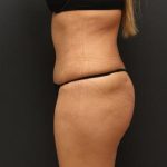 Tummy Tuck Case 6864, After Treatment, Female Patient, Thumbnail 5