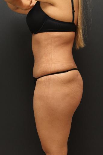 Tummy Tuck Case 6864, After Treatment, Female Patient, Set 5