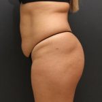 Tummy Tuck Case 6864, Before Treatment, Female Patient, Thumbnail 5