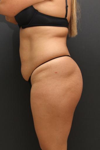 Tummy Tuck Case 6864, Before Treatment, Female Patient, Set 5