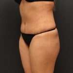 Tummy Tuck Case 6864, After Treatment, Female Patient, Thumbnail 4