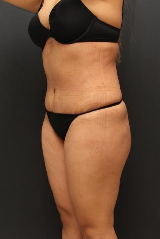 Tummy Tuck Case 6864, After Treatment, Female Patient, Set 4