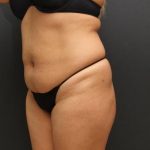 Tummy Tuck Case 6864, Before Treatment, Female Patient, Thumbnail 4