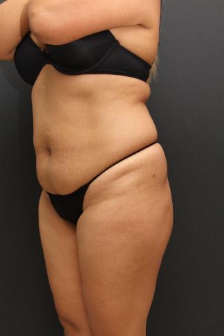Tummy Tuck Case 6864, Before Treatment, Female Patient, Set 4