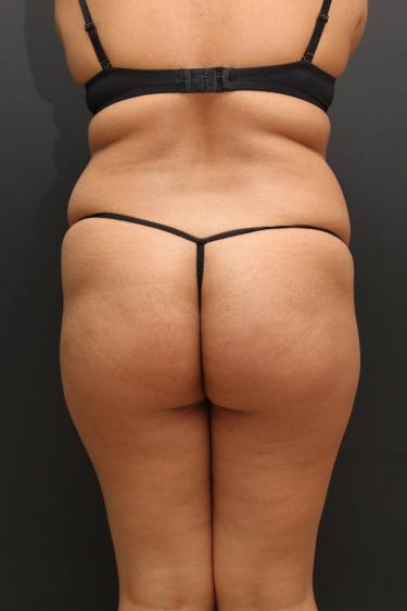 Tummy Tuck Case 6864, Before Treatment, Female Patient, Set 6