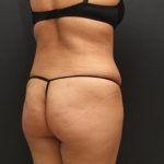 Tummy Tuck Case 6864, After Treatment, Female Patient, Thumbnail 7
