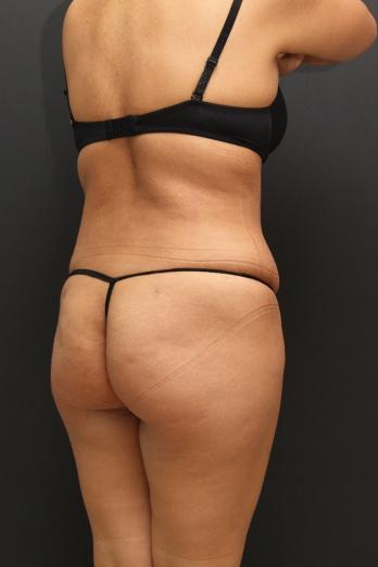 Tummy Tuck Case 6864, After Treatment, Female Patient, Set 7