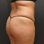 Tummy Tuck Case 6864, Before Treatment, Female Patient, Thumbnail 7