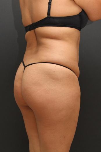 Tummy Tuck Case 6864, Before Treatment, Female Patient, Set 7