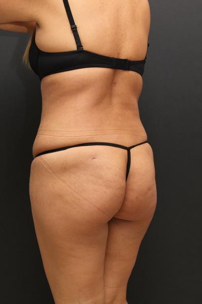 Tummy Tuck Case 6864, After Treatment, Female Patient, Set 8