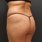 Tummy Tuck Case 6864, Before Treatment, Female Patient, Thumbnail 8