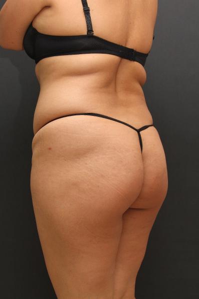 Tummy Tuck Case 6864, Before Treatment, Female Patient, Set 8