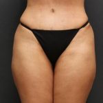 Tummy Tuck Case 6865, After Treatment, Female Patient, Thumbnail 1